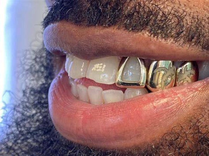 Are gold teeth valuable?