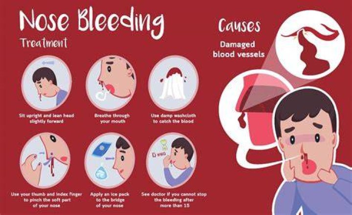 Can a head injury cause nose bleeds?