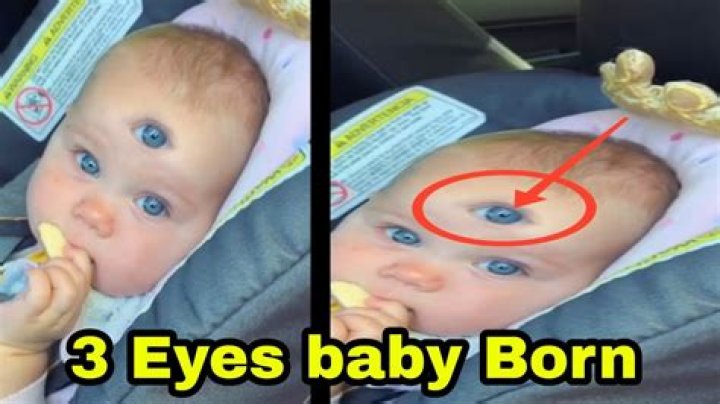 Can a person be born with 3 eyes?