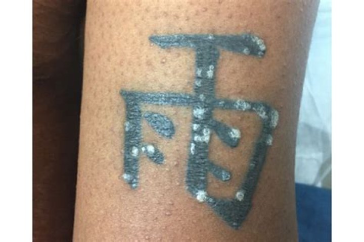 Can a rash ruin a tattoo?