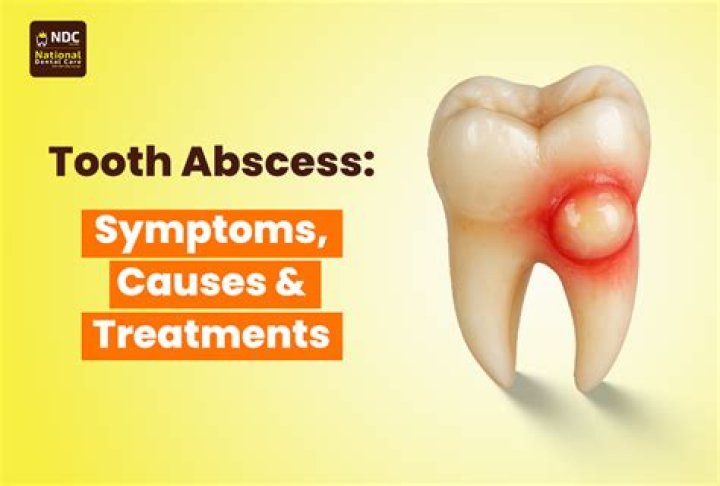 Can a tooth abscess make you tired?