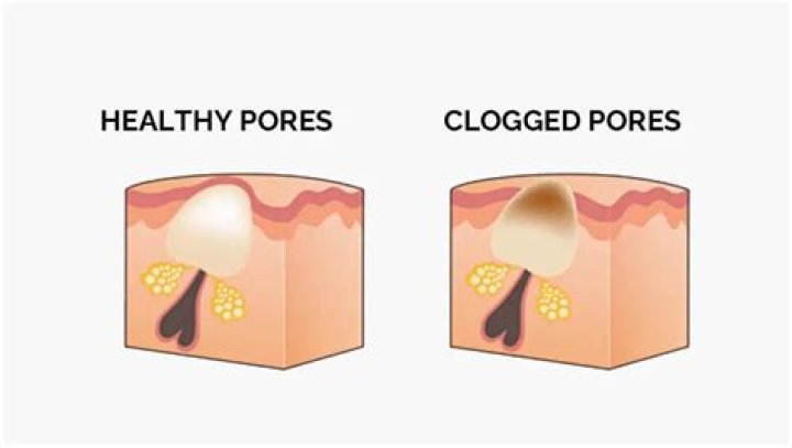 Can aloe clog your pores?