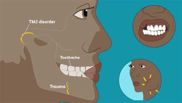 Can chewing on one side cause facial asymmetry?
