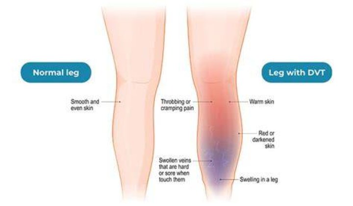 Can DVT cause leg pain?