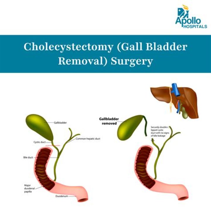 Can gallbladder be removed during C section?