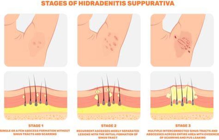 Can hidradenitis suppurativa be cancerous?