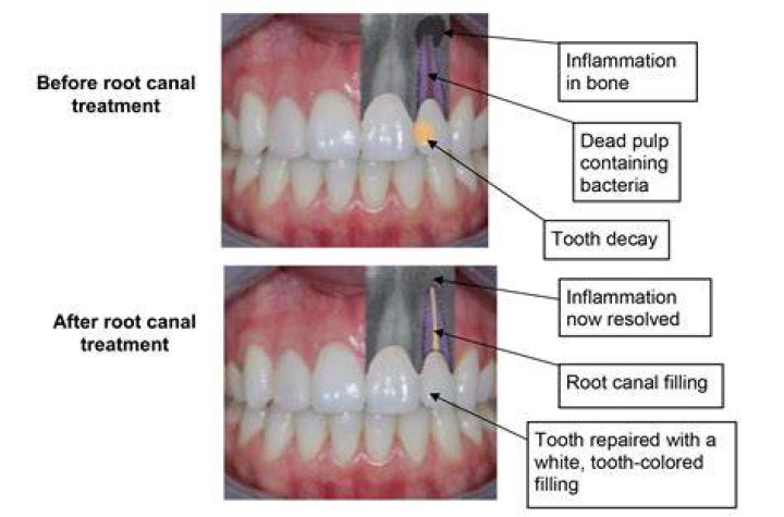 Can I drink hot water after root canal?