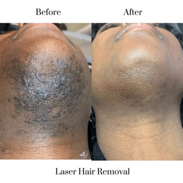 Can laser removal blonde facial hair?