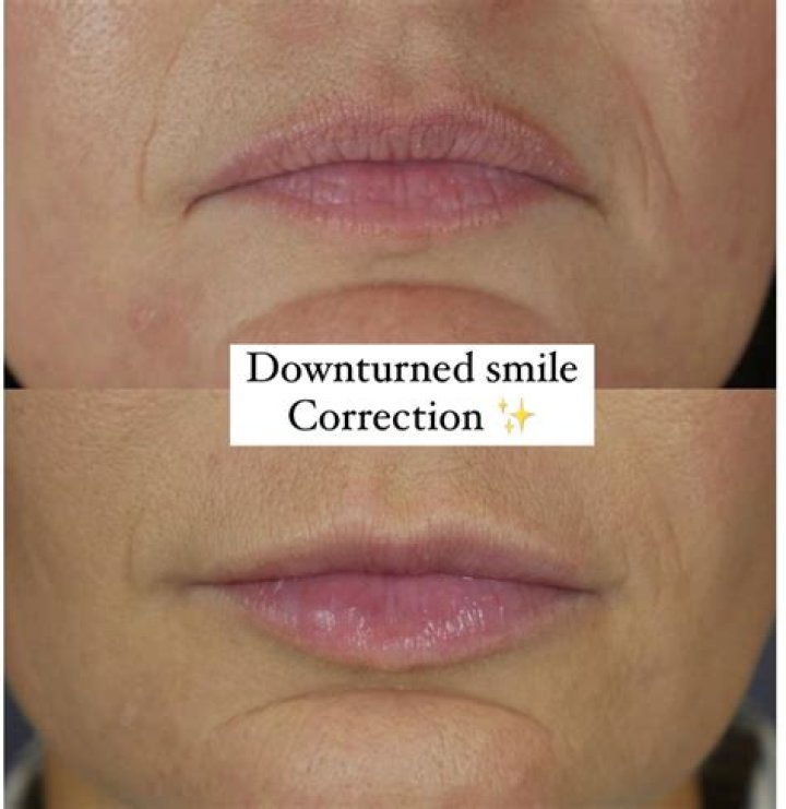Can lip injections change your smile?