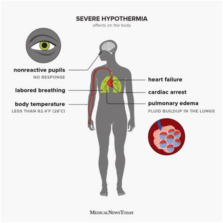 Can severe hypothermia cause brain damage?