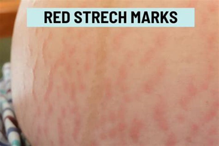 Can stretch marks itch?