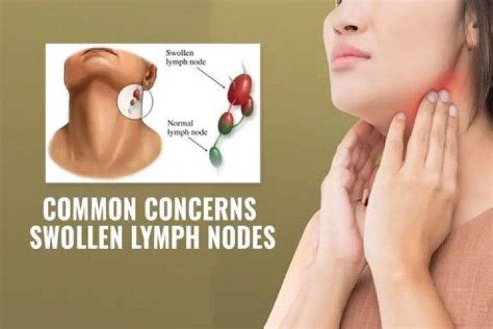 Can swollen lymph nodes cause hoarse voice?