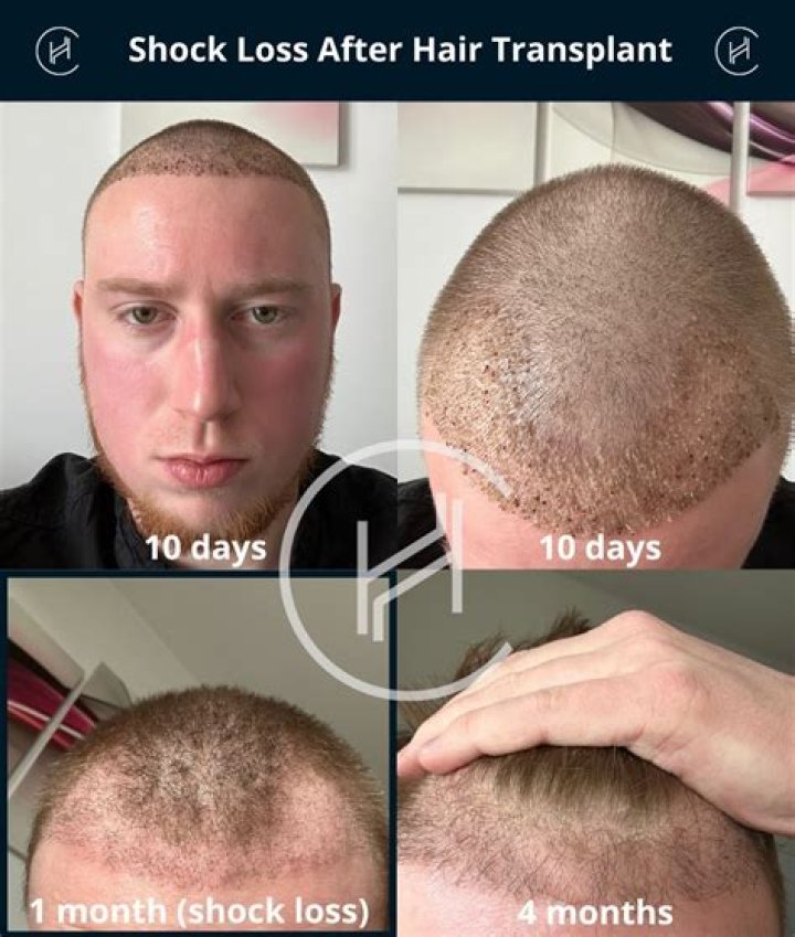 Can we workout after hair transplant?