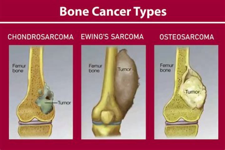 Can you die from osteosarcoma cancer?