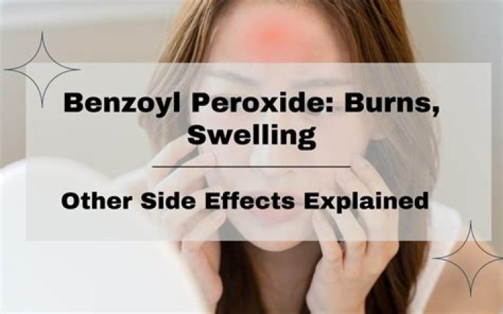 Can you get a chemical burn from benzoyl peroxide?