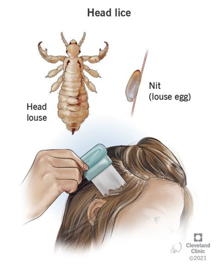 Can you get lice with a shaved head?