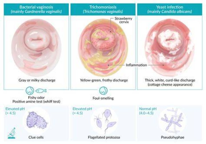 Can you get trichomoniasis from eating pork?