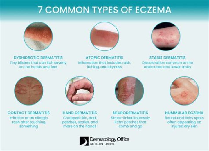 Can you shave if you have eczema?