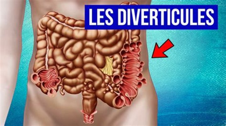 Comment soigner un Dolichocolon ?