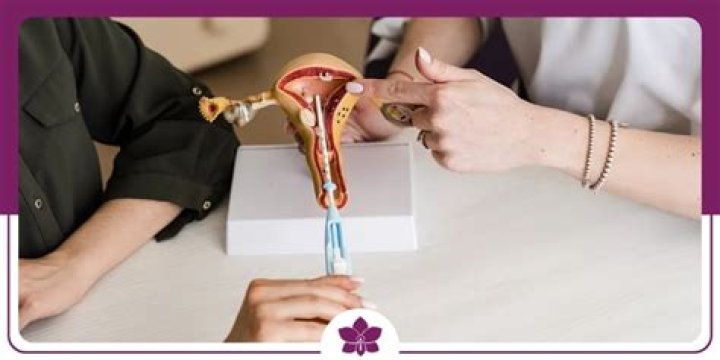 ¿Cómo afecta el DIU en la mujer?