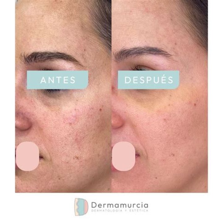¿Cómo combatir el Demodex en la cara?