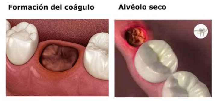 ¿Cómo cortar hemorragia después de sacar una muela?