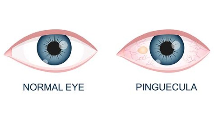 ¿Cómo evitar que crezca la Pinguecula?