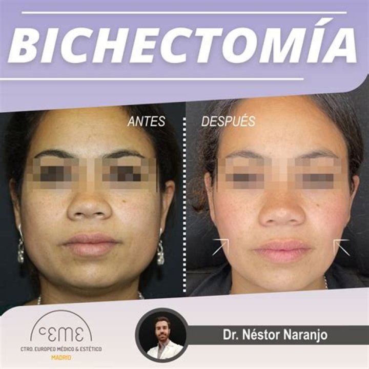 ¿Cómo queda la cara después de una Bichectomia?