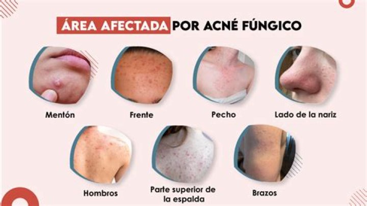 ¿Cómo se cura el acné Quistico?