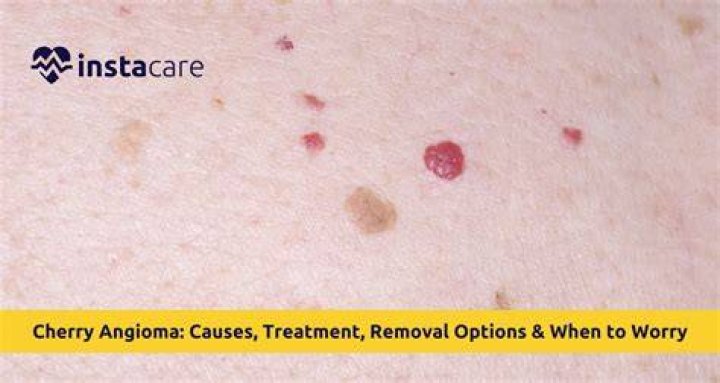 Does IPL get rid of cherry angiomas?