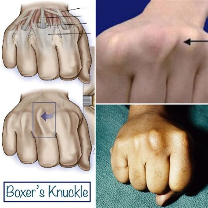 Does punching a punching bag make your knuckles stronger?