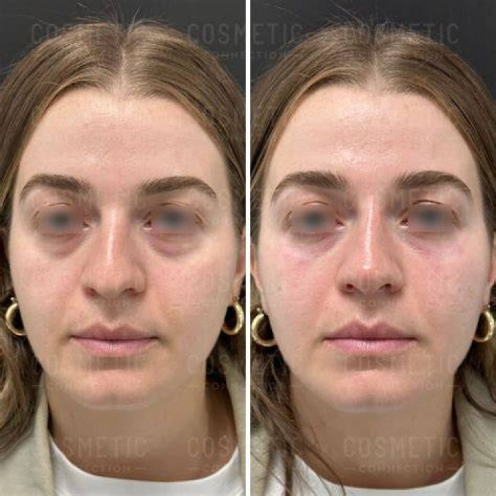 Does Sculptra help with under eye bags?