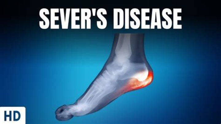 Does taping help Sever's disease?