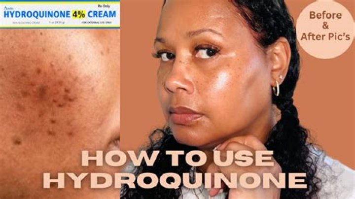 Has hydroquinone been banned in Europe?