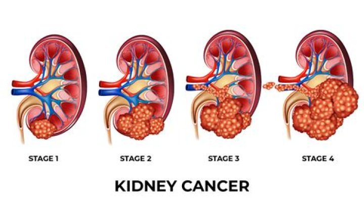 How do I know if my kidney mass is cancerous?