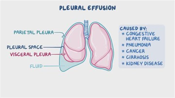 How do you count pleural fluid cells?