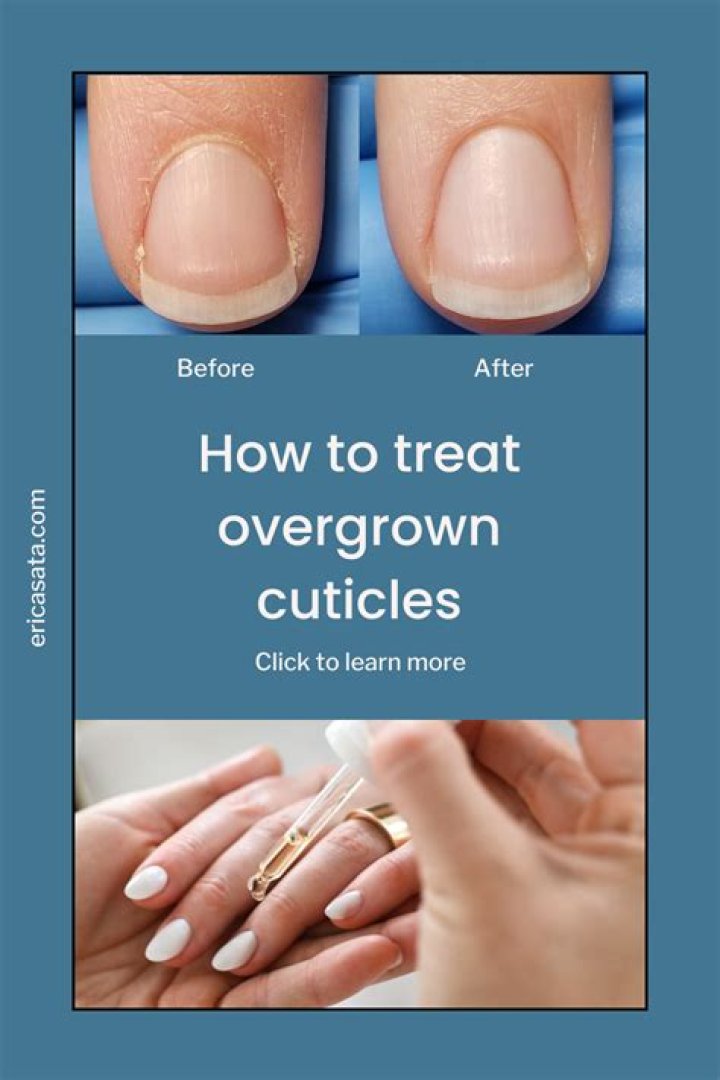 How do you stop skin from growing over your nails?