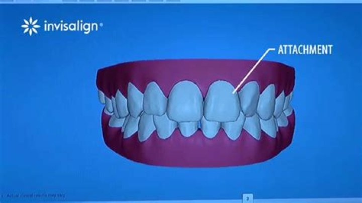 How does Invisalign move teeth down?