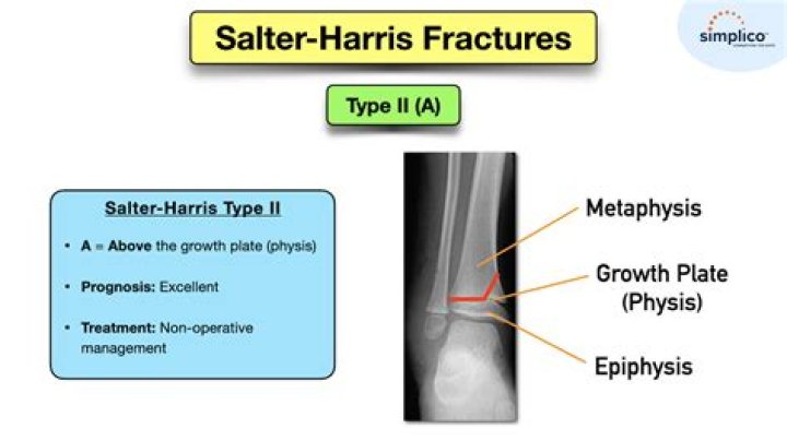 How long does it take for a Salter Harris Type 2 fracture to heal?