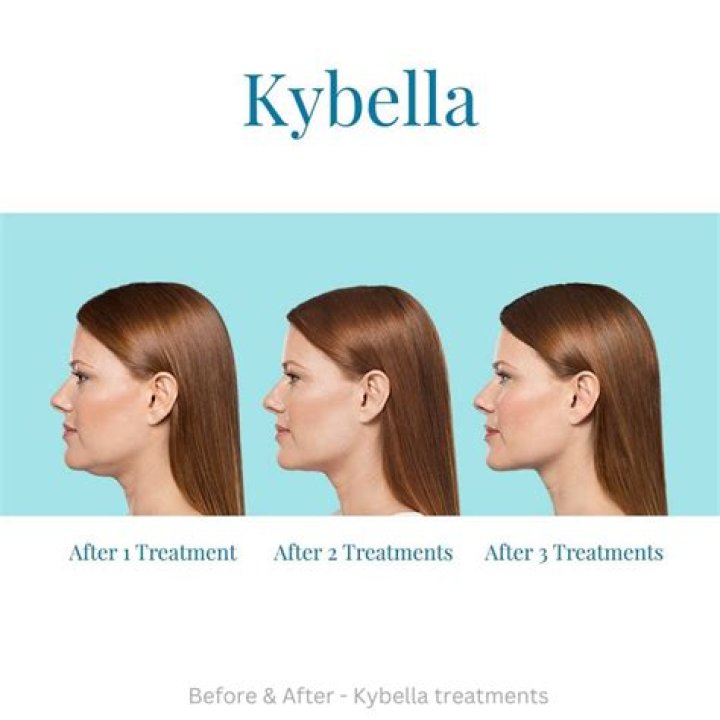 How long does it take for skin to tighten after Kybella?