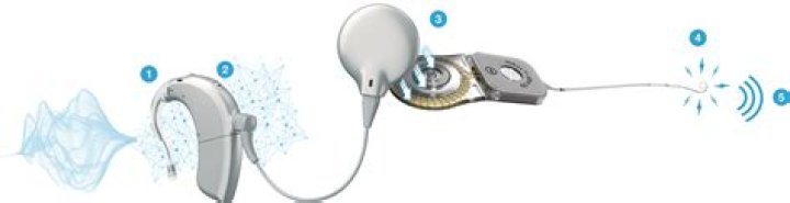 Is a cochlear implant magnetic?