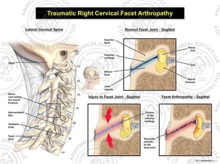 Is facet arthropathy serious?
