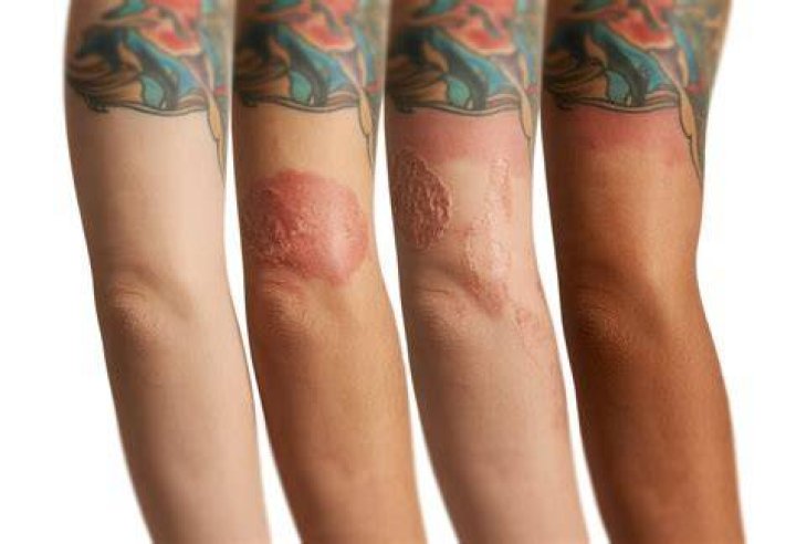 Is it normal for a new tattoo to be hot?