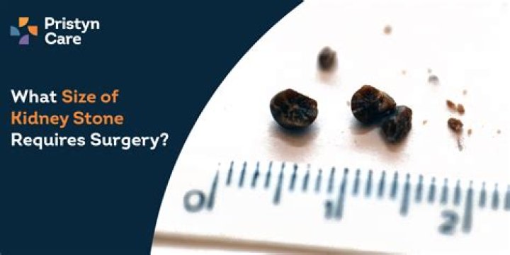 Is it possible to pass a 6mm kidney stone?