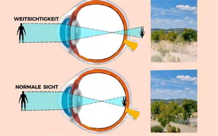 Kann Alterssichtigkeit operiert werden?