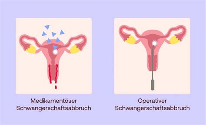 Kann man nach Ausschabung direkt wieder schwanger werden?