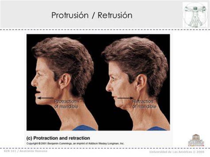 ¿Qué es Retrusion mandibular?
