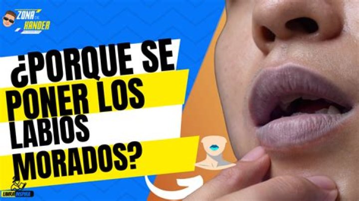 ¿Qué significa que tengas los labios morados?
