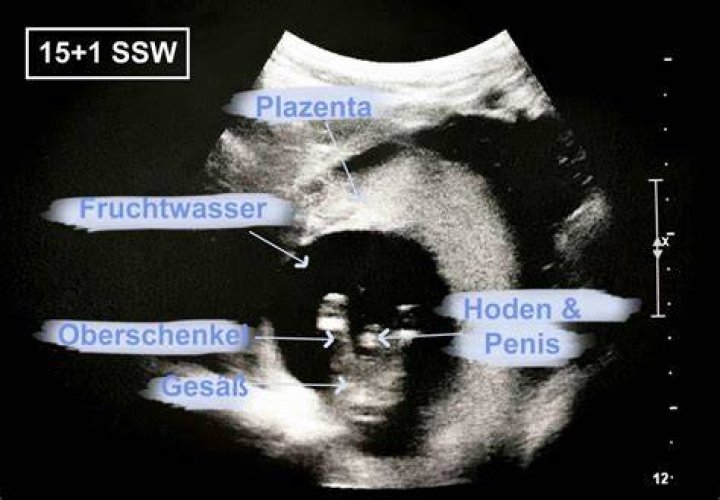 Was sieht man in der 10 SSW auf dem Ultraschall?