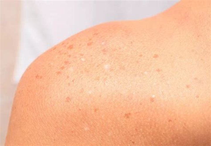 What are white spots on skin from sun?